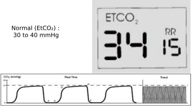 Normal (EtCO₂) _  30 to 40 mmHg